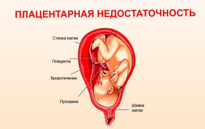 Что такое плацентарная недостаточность при беременности