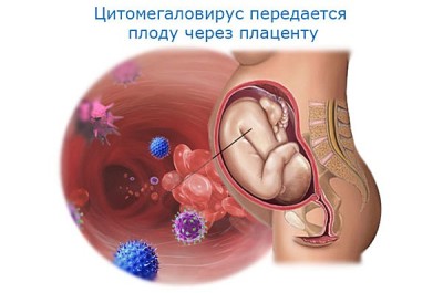 Цитомегаловирус – что это такое при беременности