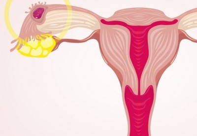 Что такое внематочная беременность?